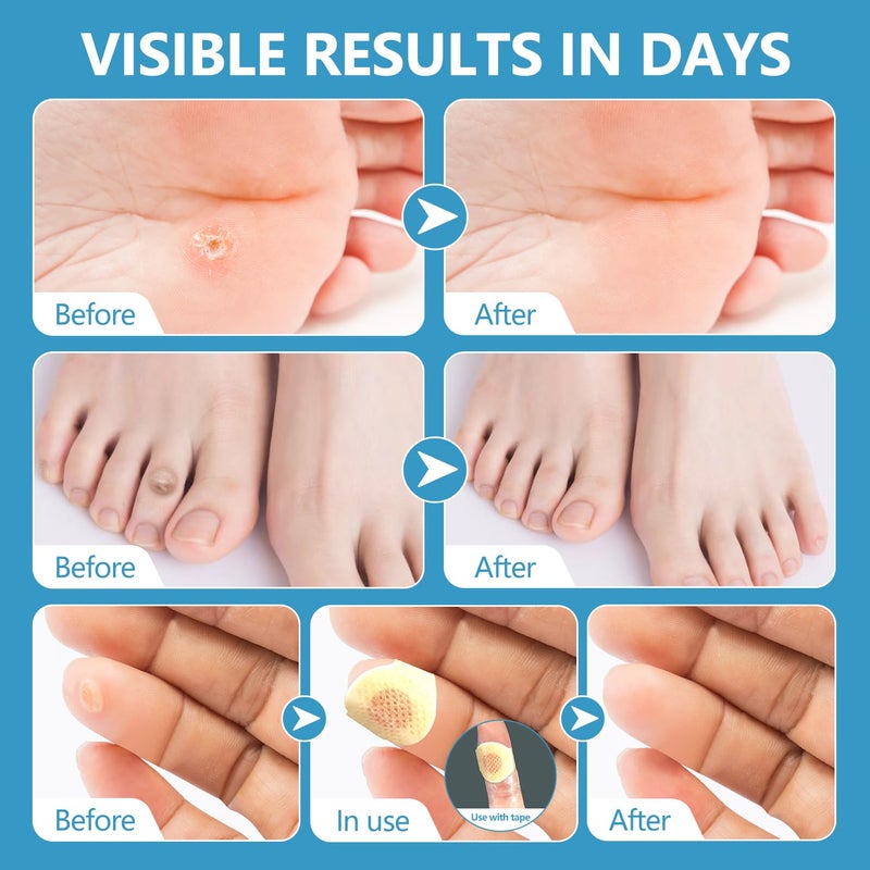 RHAICARE Corn removers for Toes feet Bottom of Foot Corn Remover,Corn Pads Callus Remover for Toes feet with 40% Salicylic 36 Count - Image 5